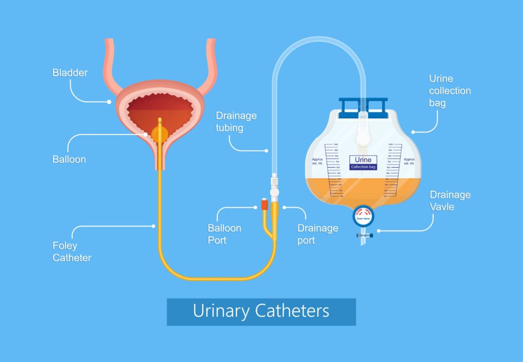 Details 62+ foley bag catheter insertion procedure super hot ...