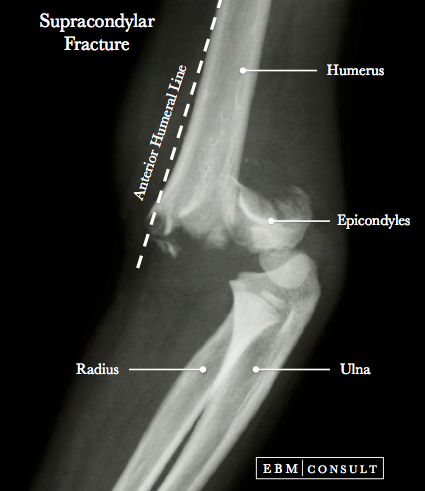 Supracondylar Distal Humerus Fracture