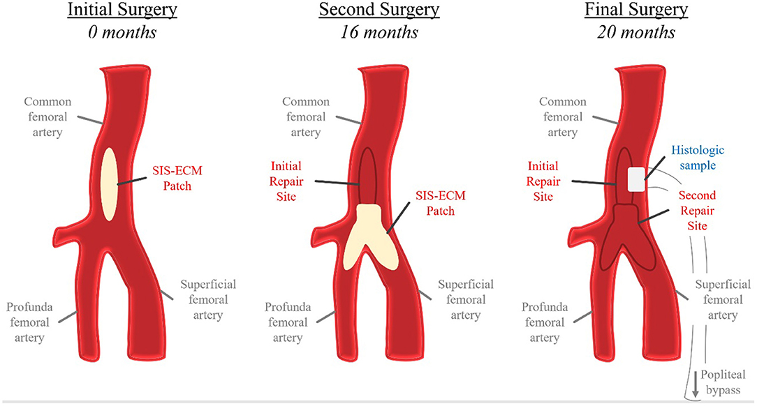 Endarterectomy