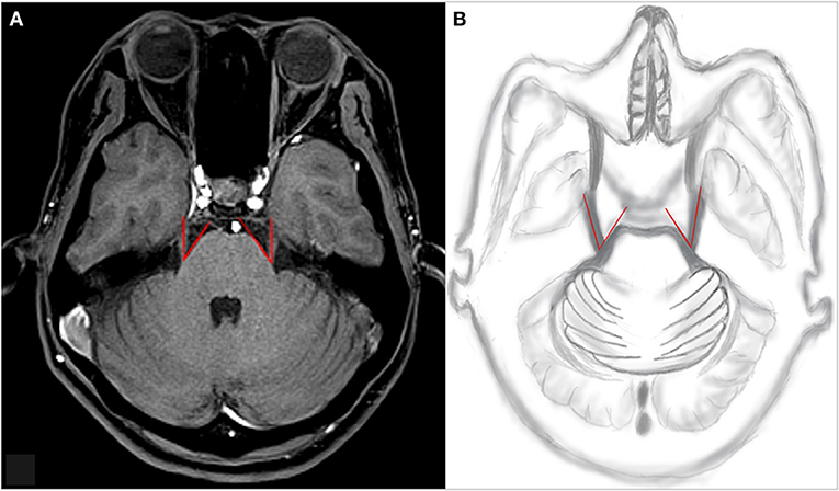 Trigeminal Nerve Mri Sagittal