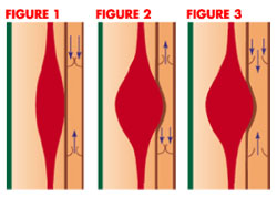 Science of Standing Venous Pump