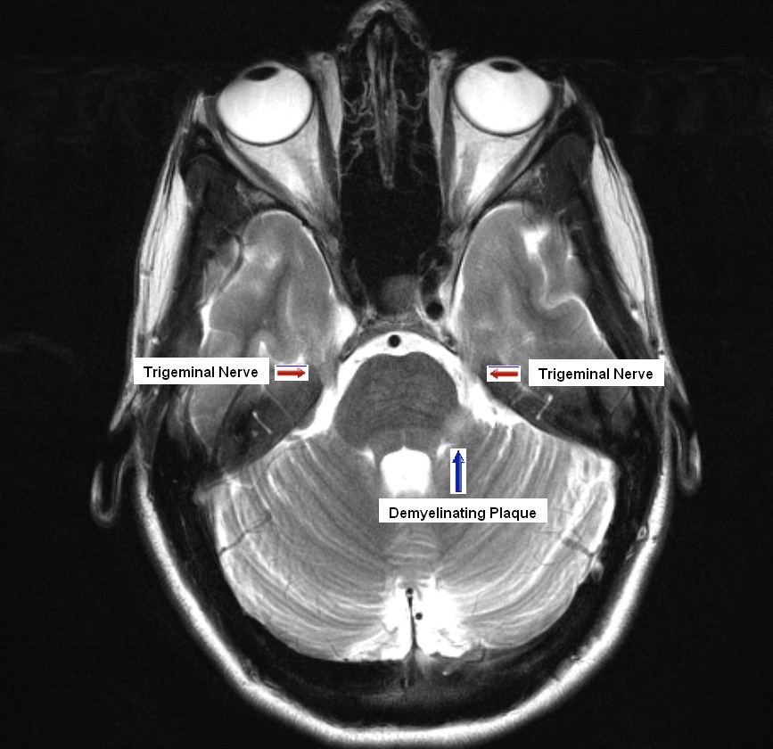 Trigeminal Nerve Mri Sagittal