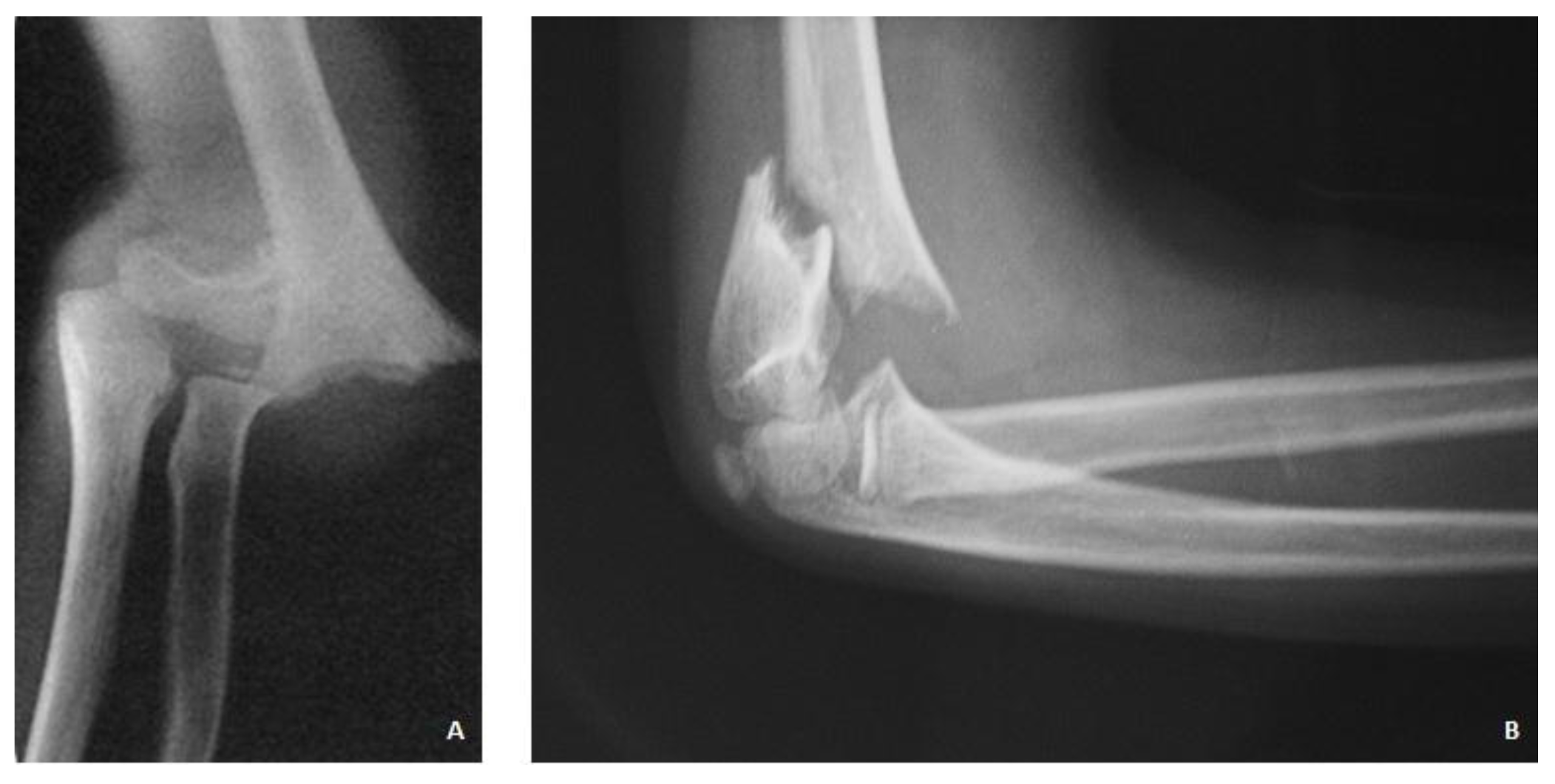 Supracondylar Humerus Fracture