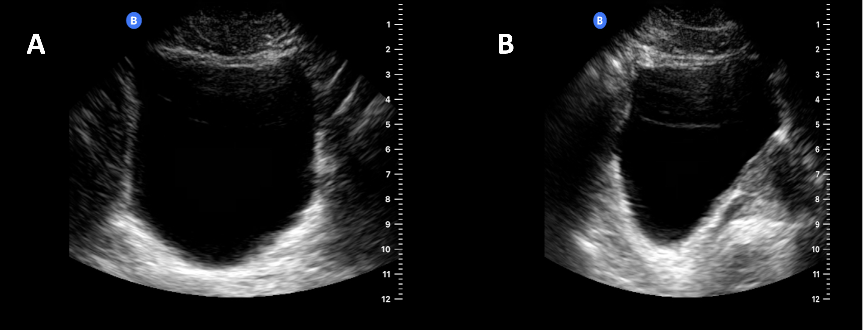 Normal Bladder Ultrasound