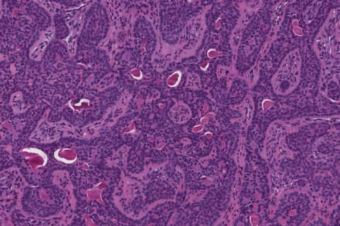 Basal cell adenoma of the salivary glands | Ottawa Atlas of Pathology