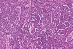 Basal cell adenoma of the salivary glands | Ottawa Atlas of Pathology