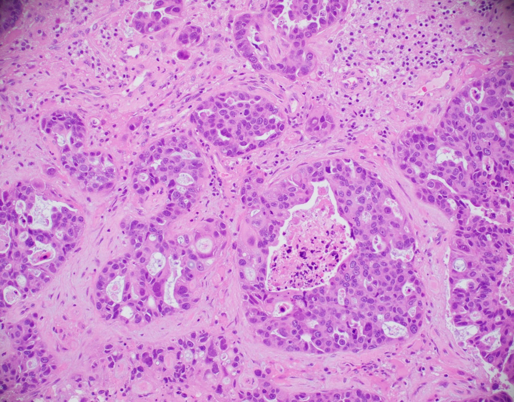 Breast Cancer Histology Overview Ductal Carcinoma In - vrogue.co