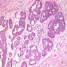 Pathology Outlines - DCIS - general