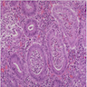 Pathology Outlines - Ulcerative colitis