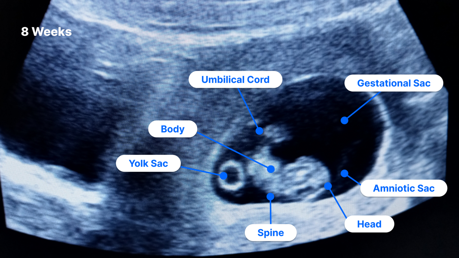 8 Weeks Pregnant Ultrasound | PocketHealth