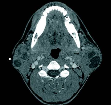 Parotid Gland Swelling Differential Diagnosis