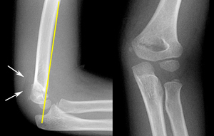 Type 3 Supracondylar Fracture