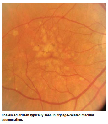 Coalesced drusen typically seen in dry age-related macular
degeneration.