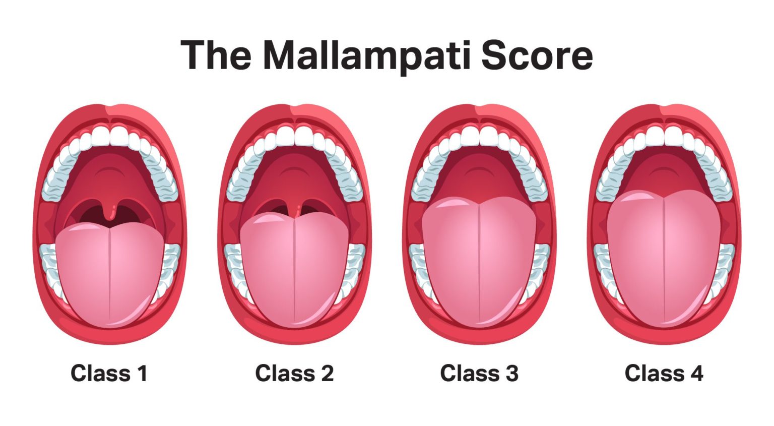 Mallampati Score and Predicting Sleep Apnea | Sleep Foundation