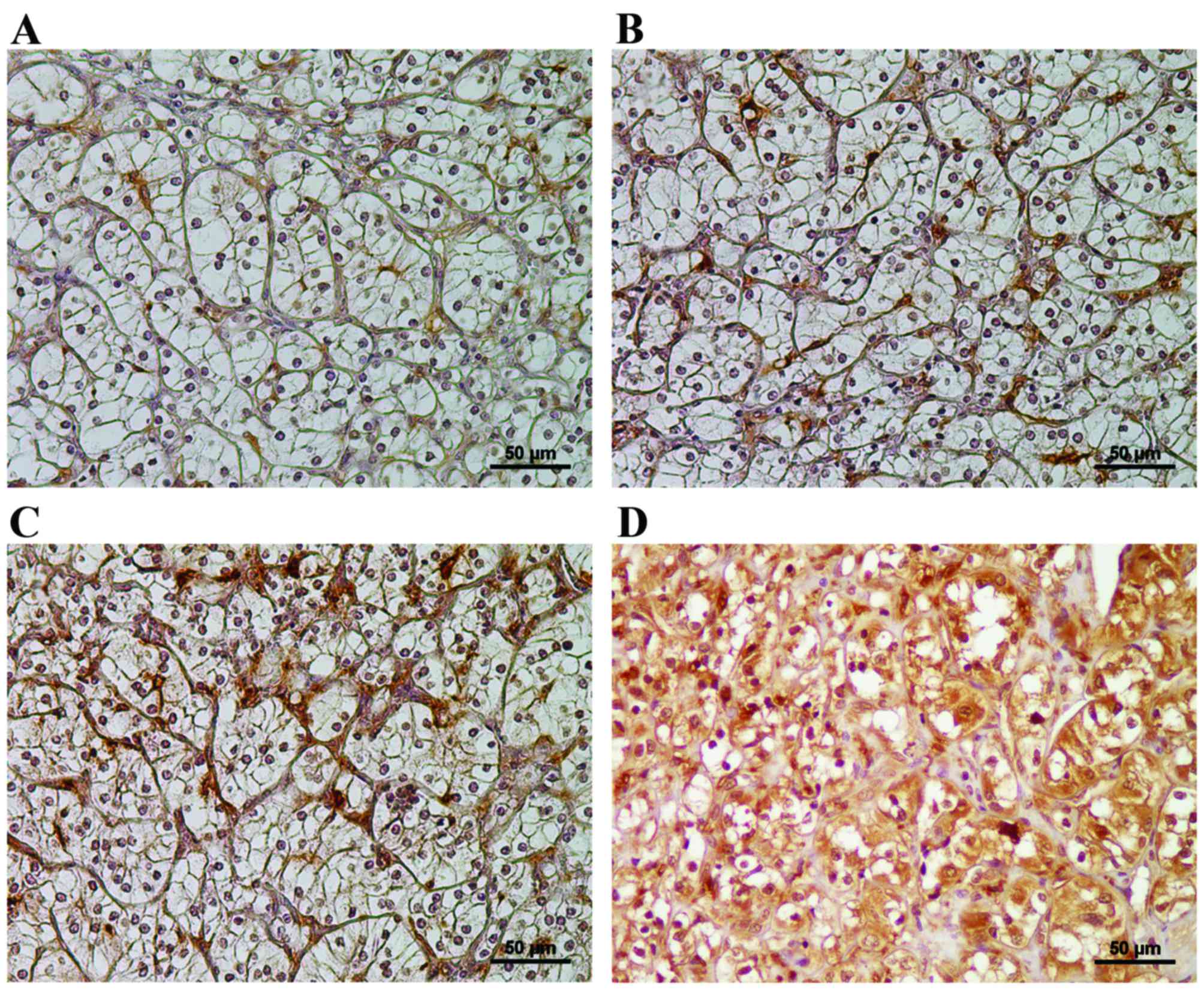 Stromal expression of Fer suppresses tumor progression in renal cell ...