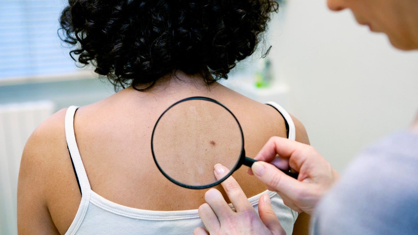 4 early signs of skin cancer no one told you about