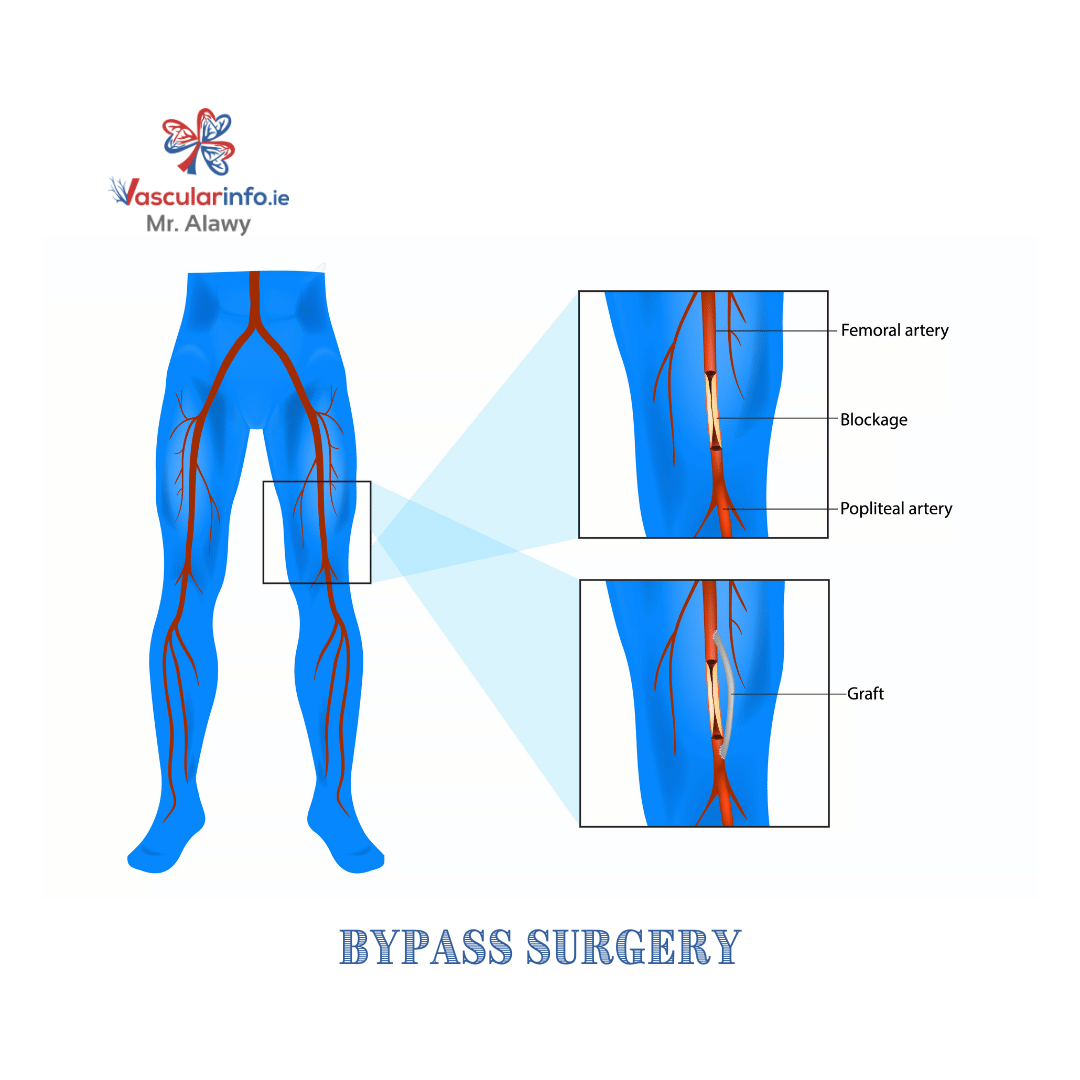 Popliteal Artery